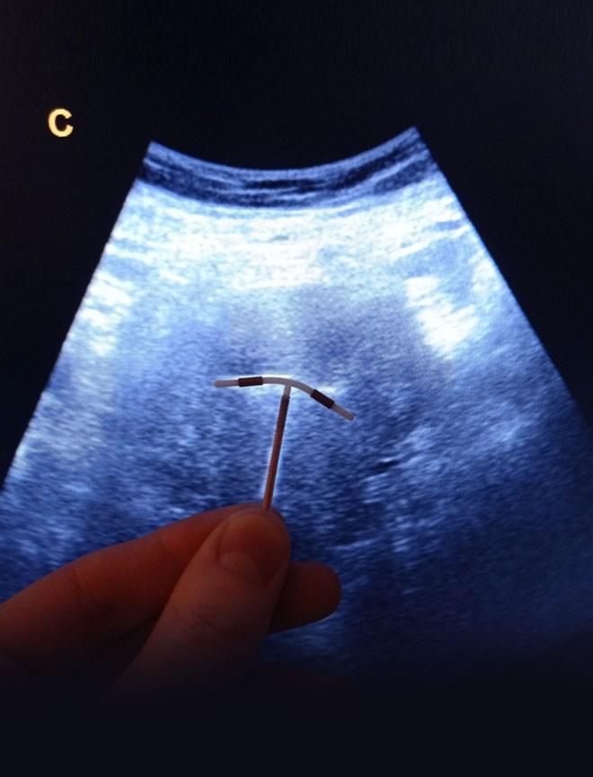 Hysteroscopic Copper T Removal in Pune – Safe & Precise IUD Removal